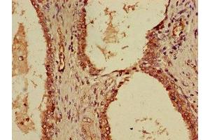 Immunohistochemistry of paraffin-embedded human prostate cancer using ABIN7156122 at dilution of 1:100 (KPNA4 antibody  (AA 51-239))