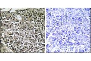Immunohistochemistry analysis of paraffin-embedded human breast carcinoma tissue, using NFAT3 (Ab-676) Antibody. (NFATC4 antibody  (AA 642-691))
