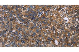 Immunohistochemistry of paraffin-embedded Human ovarian cancer tissue using LGALS2 Polyclonal Antibody at dilution 1:30 (Galectin 2 antibody)