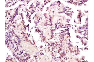 Formalin-fixed and paraffin embedded human gastric carcinoma labeled with Anti-Phospho-MDM2(Thr218) Polyclonal Antibody, Unconjugated (ABIN802533) at 1:200 followed by conjugation to the secondary antibody and DAB staining (MDM2 antibody  (pThr218))
