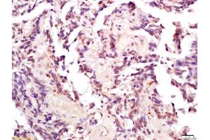 Formalin-fixed and paraffin embedded human gastric carcinoma labeled with Anti-Phospho-MDM2(Thr218) Polyclonal Antibody, Unconjugated (ABIN802533) at 1:200 followed by conjugation to the secondary antibody and DAB staining