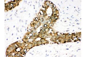 Anti- Annexin A3 Picoband antibody, IHC(P) IHC(P): Human Mammary Cancer Tissue (Annexin A3 antibody  (Middle Region))