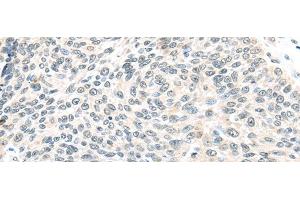 Immunohistochemistry of paraffin-embedded Human lung cancer tissue using ELOC Polyclonal Antibody at dilution 1:40 (TCEB1 antibody)