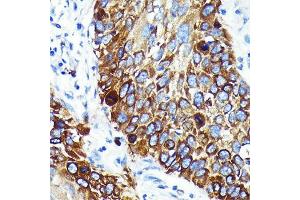 Immunohistochemistry of paraffin-embedded human lung cancer using Cathepsin B Rabbit mAb (ABIN7266148) at dilution of 1:100 (40x lens). (Cathepsin B antibody)