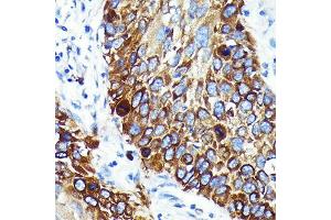 Immunohistochemistry of paraffin-embedded human lung cancer using Cathepsin B Rabbit mAb (ABIN7266148) at dilution of 1:100 (40x lens). (Cathepsin B antibody)