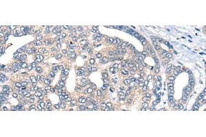 Immunohistochemistry of paraffin-embedded Human liver cancer tissue using AURKA Polyclonal Antibody at dilution of 1:40(x200) (Aurora A antibody)