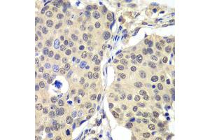 Immunohistochemistry of paraffin-embedded human lung cancer using CCNC antibody. (Cyclin C antibody)