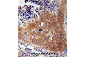 FBXW8 Antibody (Center) immunohistochemistry analysis in formalin fixed and paraffin embedded human lung carcinoma followed by peroxidase conjugation of the secondary antibody and DAB staining. (FBXW8 antibody  (Middle Region))