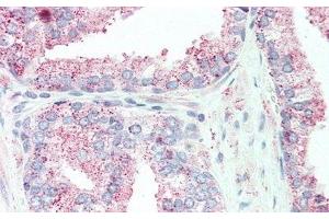 Detection of TNFaIP6 in Human Prostate Tissue using Polyclonal Antibody to Tumor Necrosis Factor Alpha Induced Protein 6 (TNFaIP6) (TNFAIP6 antibody  (AA 18-275))