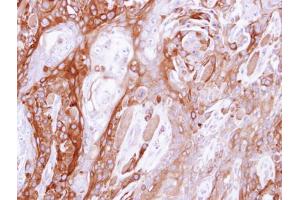 IHC-P Image Immunohistochemical analysis of paraffin-embedded CA922 xenograft, using UBE4B, antibody at 1:500 dilution. (UBE4B antibody  (C-Term))