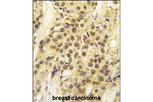 Formalin-fixed and paraffin-embedded human breast carcinoma tissue reacted with MYST1 polyclonal antibody  , which was peroxidase-conjugated to the secondary antibody, followed by DAB staining.