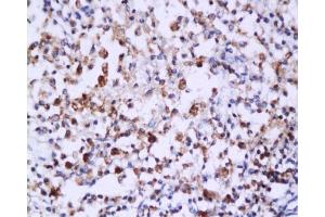 Formalin-fixed and paraffin embedded: human endometrium carcinoma labeled with Anti-Caspase-6 Polyclonal Antibody , Unconjugated 1:200 followed by conjugation to the secondary antibody and DAB staining (Caspase 6 antibody  (AA 151-250))