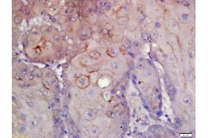 Formalin-fixed and paraffin embedded human laryngeal carcinoma labeled with Rabbit Anti-CD276/B7H3 Polyclonal Antibody, Unconjugated (ABIN1385603) at 1:200 followed by conjugation to the secondary antibody and DAB staining