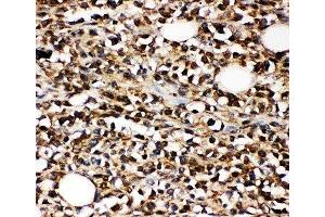IHC-P: CD10 antibody testing of human B-lymphocyte cancer tissue (MME antibody  (AA 52-750))