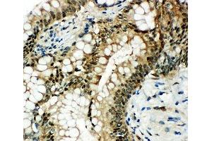 IHC-P: HSP70 antibody testing of human intestinal cancer tissue (HSP70 antibody  (AA 577-596))