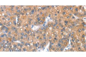 Immunohistochemistry of paraffin-embedded Human liver cancer tissue using CD238 Polyclonal Antibody at dilution 1:40 (KEL antibody)