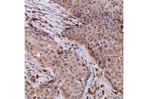 Immunohistochemical analysis of VPS54 staining in human breast cancer formalin fixed paraffin embedded tissue section. (VPS54 antibody)