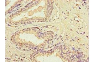 Immunohistochemistry of paraffin-embedded human prostate cancer using ABIN7149154 at dilution of 1:100 (COX1 antibody  (AA 474-513))