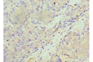 Immunohistochemistry of paraffin-embedded human colon cancer using ABIN7170948 at dilution of 1:100 (SULT1A1 antibody  (AA 1-295))