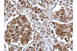 IHC-P Image EPS8 antibody [C3], C-term detects EPS8 protein at cytosol and nucleus on human breast carcinoma by immunohistochemical analysis. (EPS8 antibody  (C-Term))