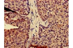 Immunohistochemistry of paraffin-embedded human ovarian cancer using ABIN7146536 at dilution of 1:100 (Calpain 14 antibody  (AA 68-366))