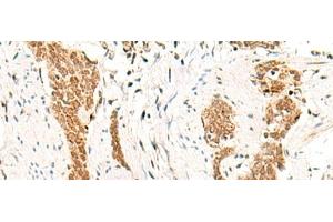 Immunohistochemistry of paraffin-embedded Human esophagus cancer tissue using HOXC13 Polyclonal Antibody at dilution of 1:60(x200) (HOXC13 antibody)