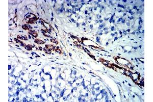 Immunohistochemical analysis of paraffin-embedded bladder cancer tissues using FLI1 mouse mAb with DAB staining. (FLI1 antibody  (AA 303-452))