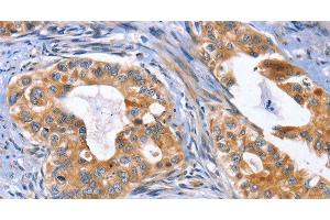 Immunohistochemistry of paraffin-embedded Human cervical cancer using MUSK Polyclonal Antibody at dilution of 1:30 (MUSK antibody)