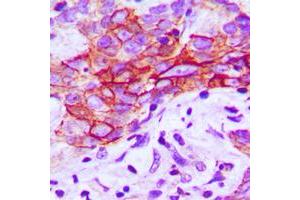 Immunohistochemical analysis of CMKLR1 staining in human breast cancer formalin fixed paraffin embedded tissue section. (CMKLR1 antibody  (Center))