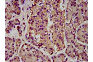 IHC image of ABIN7145642 diluted at 1:200 and staining in paraffin-embedded human pancreatic cancer performed on a Leica BondTM system.