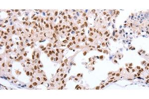 Immunohistochemistry of paraffin-embedded Human lung cancer tissue using Oct-6 Polyclonal Antibody at dilution 1:40 (POU3F1 antibody)