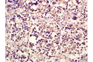 Formalin-fixed and paraffin embedded human lung carcinoma labeled with Anti-NCR3 Polyclonal Antibody, Unconjugated (ABIN739980) at 1:200 followed by conjugation to the secondary antibody and DAB staining (NCR3 antibody  (AA 81-180))