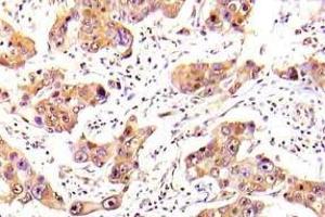Immunohistochemistry (IHC) analyzes of FKHR/FOXO1A antibody in paraffin-embedded human breast carcinoma tissue. (FOXO1 antibody)
