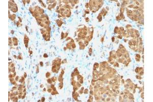 Formalin-fixed, paraffin-embedded human Melanoma stained with S100B-Monospecific Recombinant Rabbit Monoclonal Antibody (S100B/1706R). (Recombinant S100B antibody)