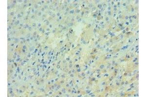 Immunohistochemistry of paraffin-embedded human liver cancer using ABIN7143277 at dilution of 1:100 (APRT antibody  (AA 1-180))