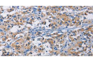 Immunohistochemistry of paraffin-embedded Human thyroid cancer tissue using RICTOR Polyclonal Antibody at dilution 1:50 (RICTOR antibody)