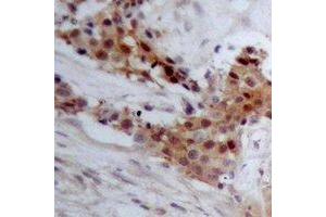 Immunohistochemical analysis of BAP1 staining in human breast cancer formalin fixed paraffin embedded tissue section. (BAP1 antibody)
