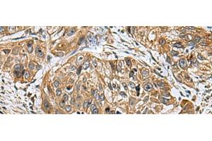 Immunohistochemistry of paraffin-embedded Human esophagus cancer tissue using EARS2 Polyclonal Antibody at dilution of 1:30(x200) (EARS2 antibody)