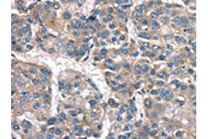 The image on the left is immunohistochemistry of paraffin-embedded Human liver cancer tissue using ABIN7190040(CACNA1G Antibody) at dilution 1/20, on the right is treated with synthetic peptide. (CACNA1G antibody)