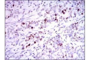 Immunohistochemical analysis of paraffin-embedded cervical cancer tissues using INCENP mouse mAb with DAB staining.