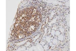 IHC-P Image Immunohistochemical analysis of paraffin-embedded human gastric cancer, using cylindromatosis 1, antibody at 1:100 dilution.