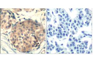 Immunohistochemical analysis of paraffin-embedded human breast carcinoma tissue using c-kit (Ab-936) Antibody (E021539). (KIT antibody)