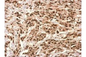 IHC-P Image UTP6 antibody detects UTP6 protein at nucleus on U251 xenograft by immunohistochemical analysis. (UTP6 antibody  (Center))