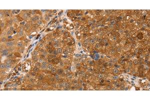 Immunohistochemistry of paraffin-embedded Human breast cancer tissue using TMSB10 Polyclonal Antibody at dilution 1:35