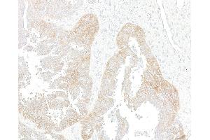 Immunohistochemistry (IHC) image for anti-Met Proto-Oncogene (MET) (C-Term) antibody (ABIN7795683)