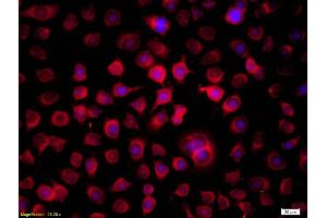 Squamous cell carcinoma stained with Anti-THRSP (ABIN720685) Squamous cell carcinoma stained with Anti-THRSP (THRSP antibody  (AA 116-145))