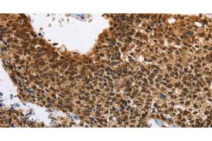 Immunohistochemistry of paraffin-embedded Human lung cancer using ELAVL1 Polyclonal Antibody at dilution of 1:40 (ELAVL1 antibody)
