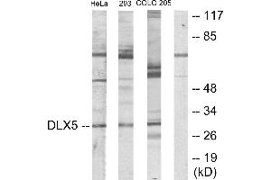 Immunohistochemistry analysis of paraffin-embedded human lung carcinoma tissue using DLX5 antibody. (DLX5 antibody)