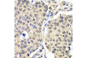 Immunohistochemistry of paraffin-embedded human lung cancer using CCNC antibody at dilution of 1:100 (x40 lens). (Cyclin C antibody)