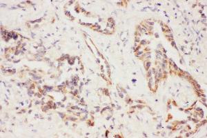 Anti-Eotaxin 3 Picoband antibody,  IHC(P): Human Lung Cancer Tissue (CCL26 antibody  (AA 24-94))